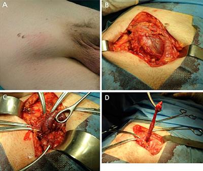 De Garengeot’s Hernia: Report of a Rare Surgical Emergency and Review of the Literature